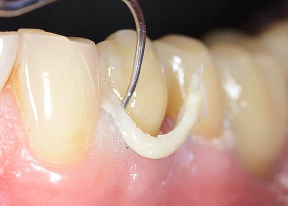 Avoiding the Top 5 Cementation Pitfalls: A Clinician's Guide