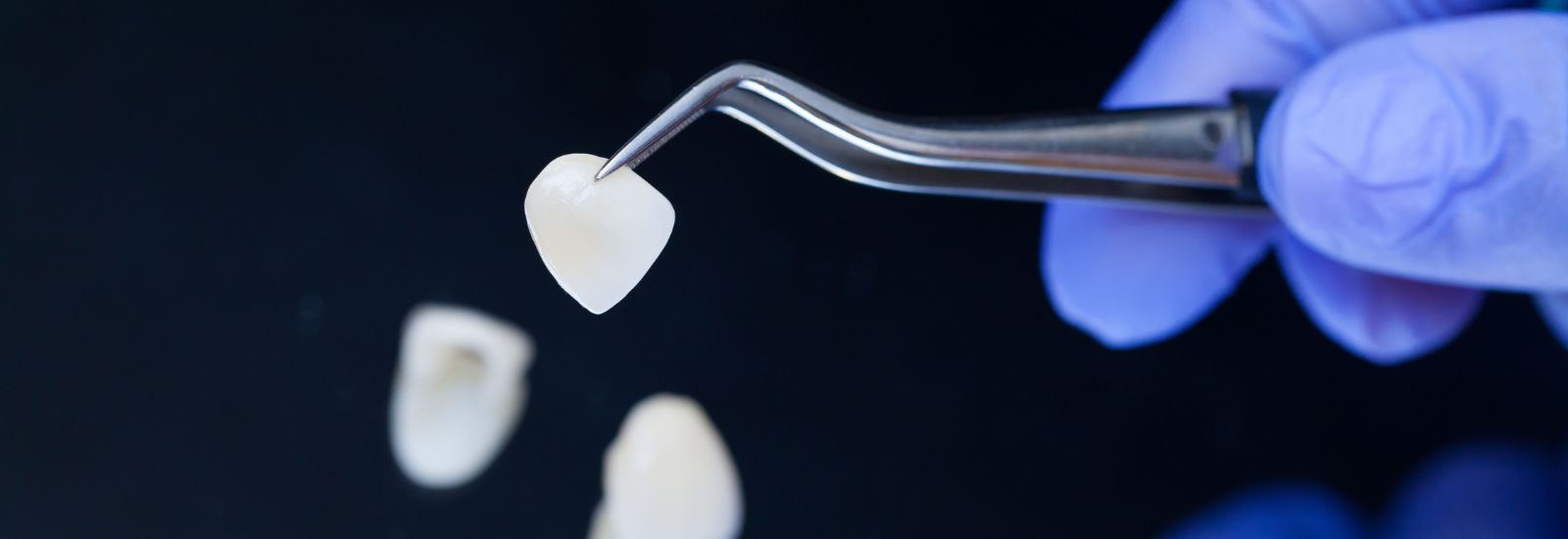 e.max vs. Zirconia: Why One Is Not Better Than the Other