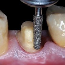 Zirconia Crown Prep: A Clinical Guide to Monolithic & PFZ Restorations